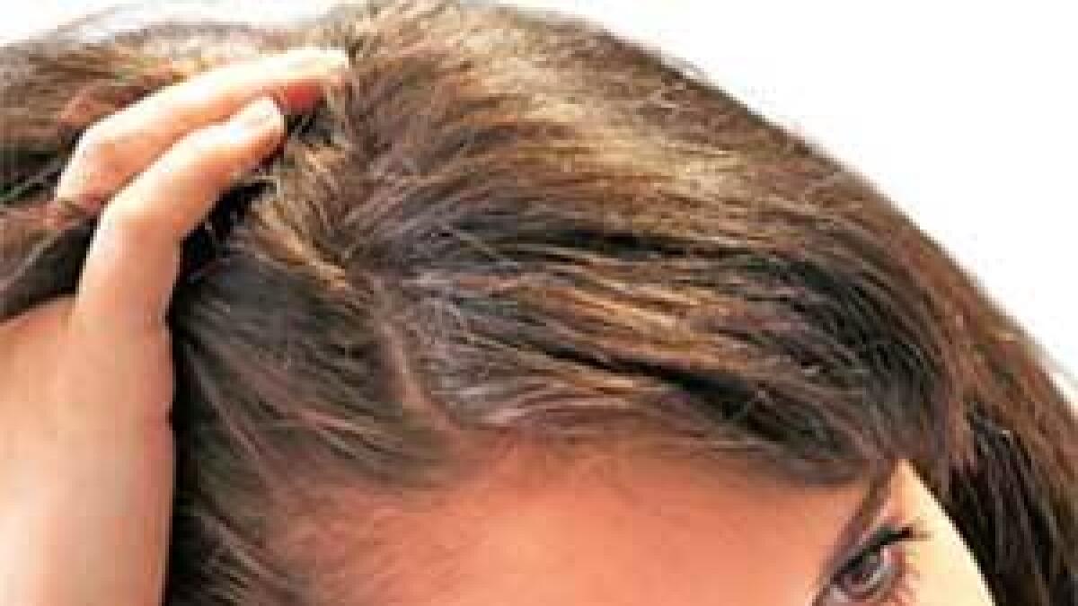Getting rid of lice nits - News | Khaleej Times