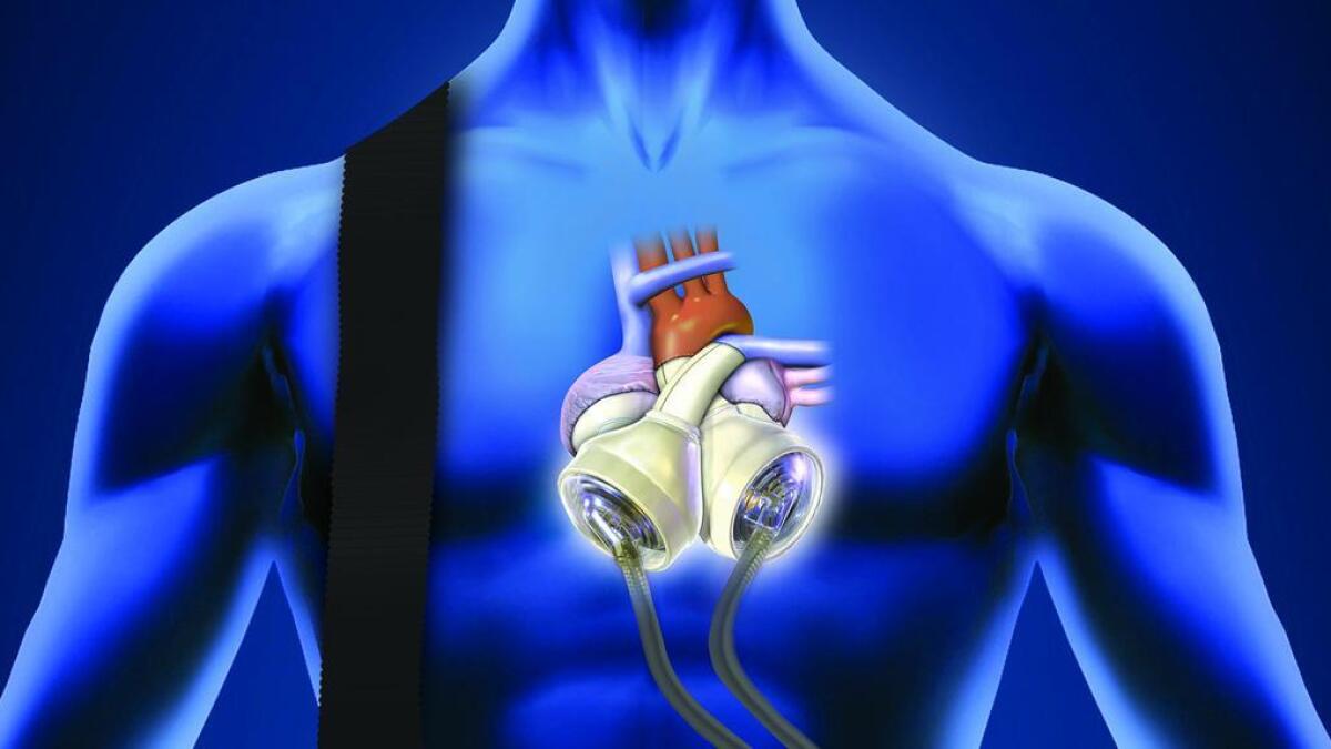 Sharjah hospital to perform total artificial heart implant - News | Khaleej  Times