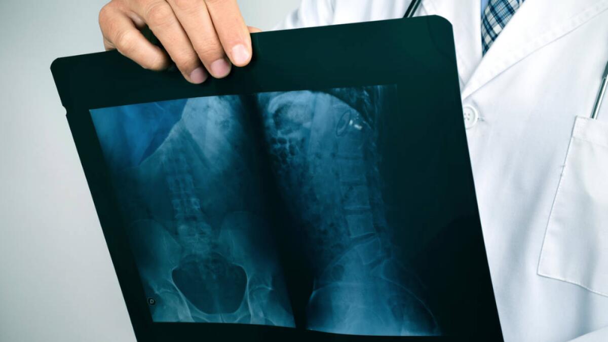 Man jailed in Dubai after X-ray shows 1kg drugs in his stomach
