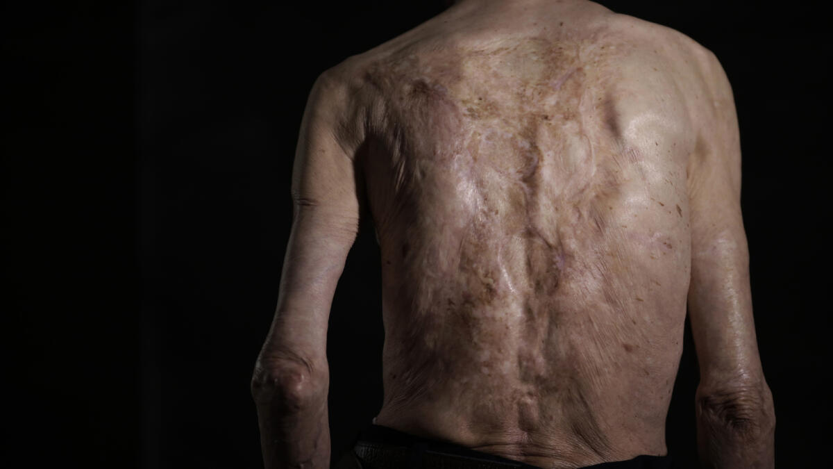 Sumiteru Taniguchi has lived a web of wounds covering most of his back. His wife still applies a moisturizing cream every morning to reduce the irritation from the scars.