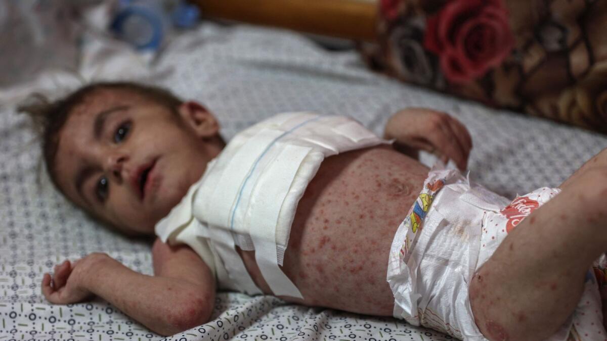 Palestinian baby girl Wateen Al Adasi who developed a skin condition due to malnutrition rests at the Kamal Adwan hospital in Beit Lahia in the northern Gaza Strip on Tuesday. — AFP