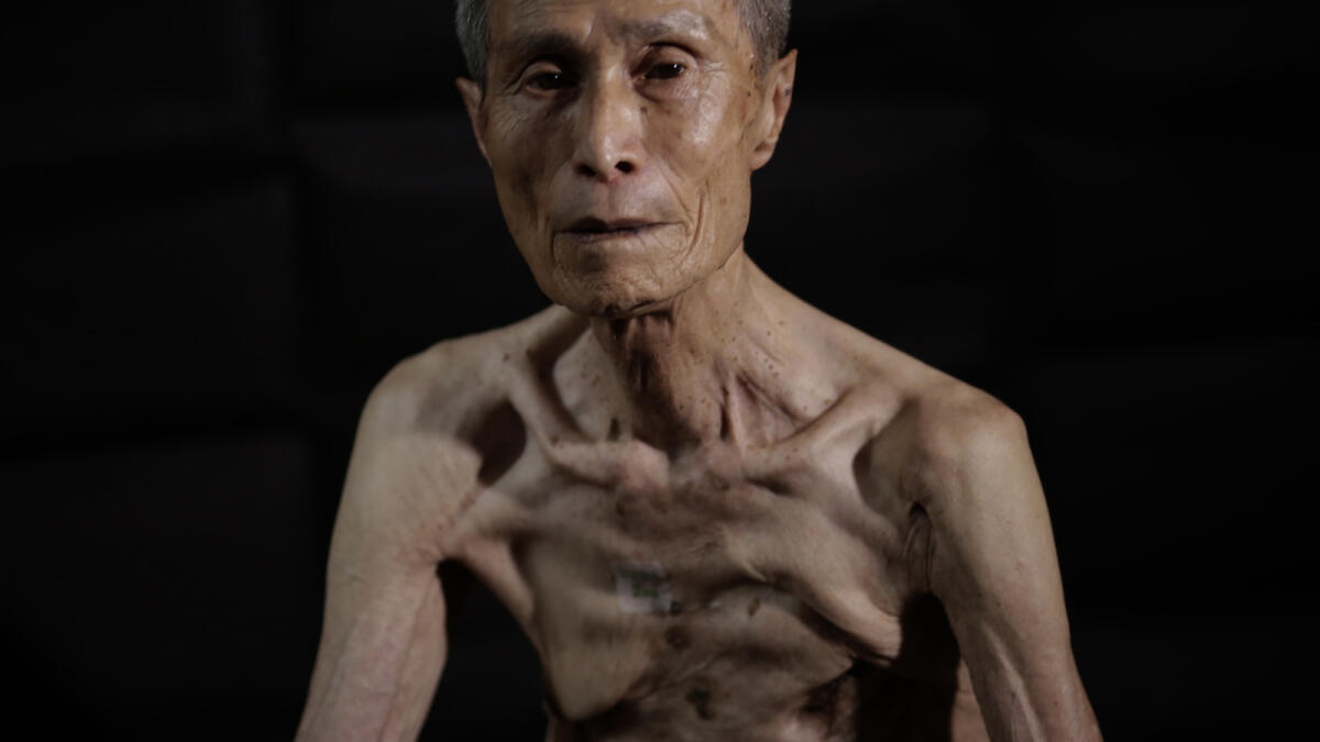 Nagasaki atomic bomb left a man scarred for life 