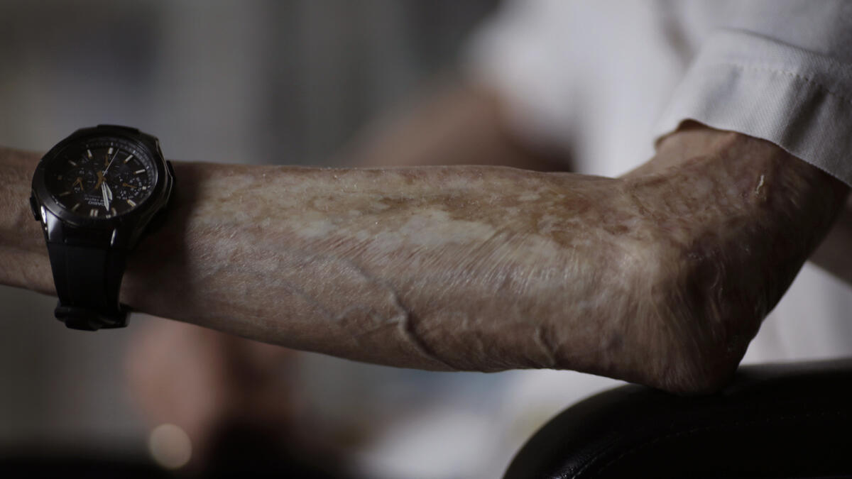 Sumiteru Taniguchi, 86, a survivor of the 1945 atomic bombing of Nagasaki shows the scars on his hand.