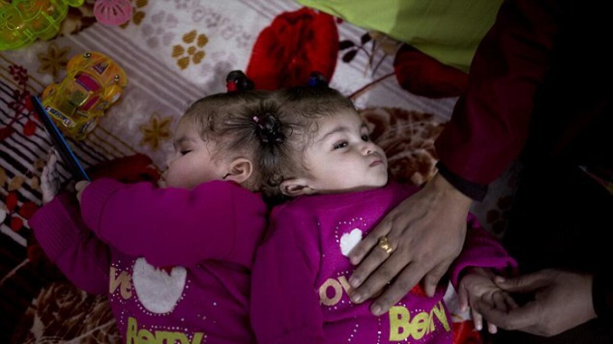 Photos: Saudi King pays for separation of conjoined Egyptian twins