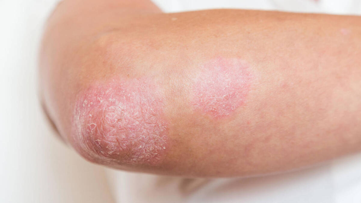 Check with doctors before going herbal, psoriasis patients told