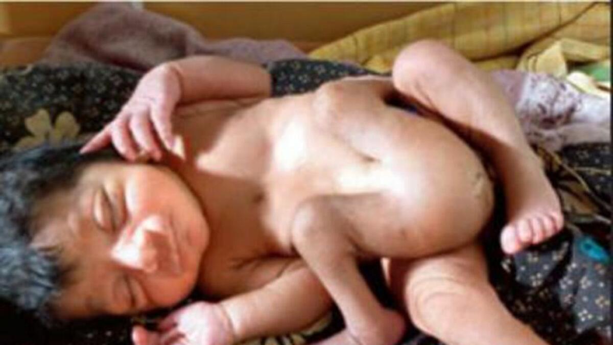 Woman delivers baby with four legs
