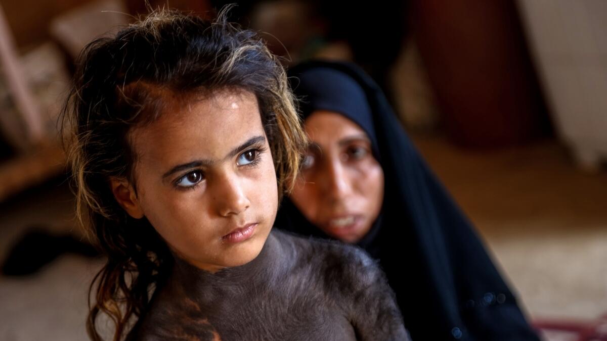 Rare congenital skin disease turns little Iraqi girl into a social outcast