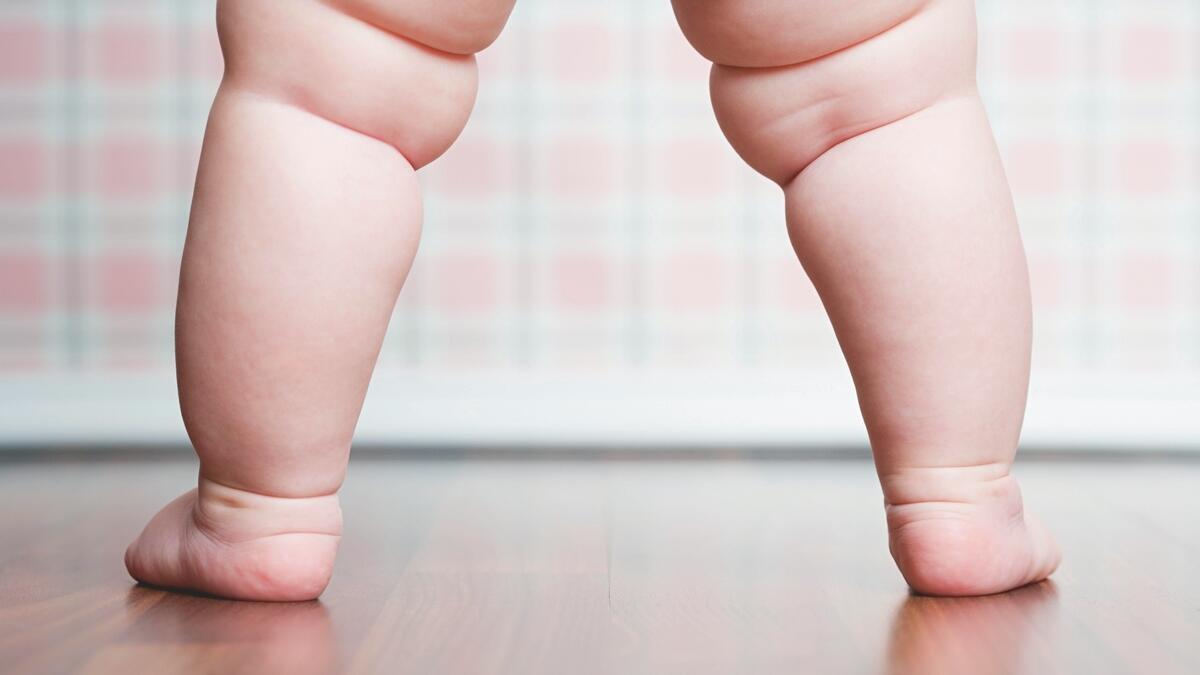 Child obesity is rising, warn doctors