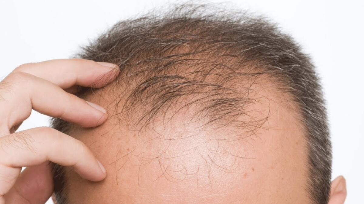 27-year-old man commits suicide due to hair fall