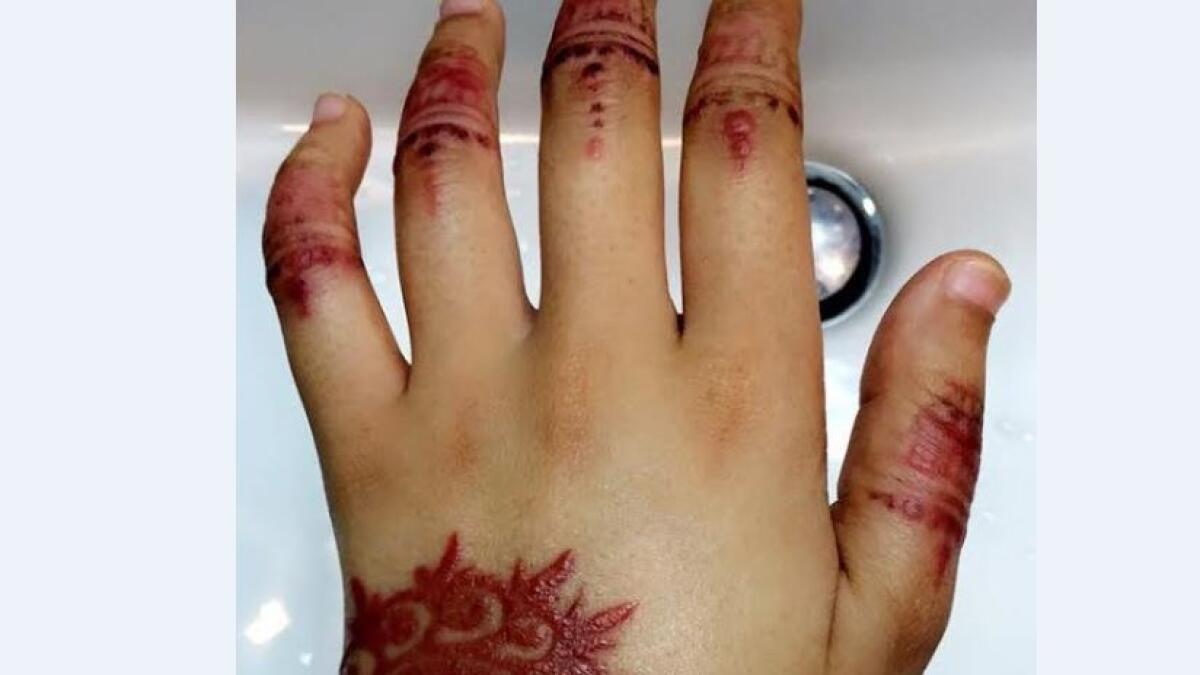 Woman rushed to emergency room after henna burns hands