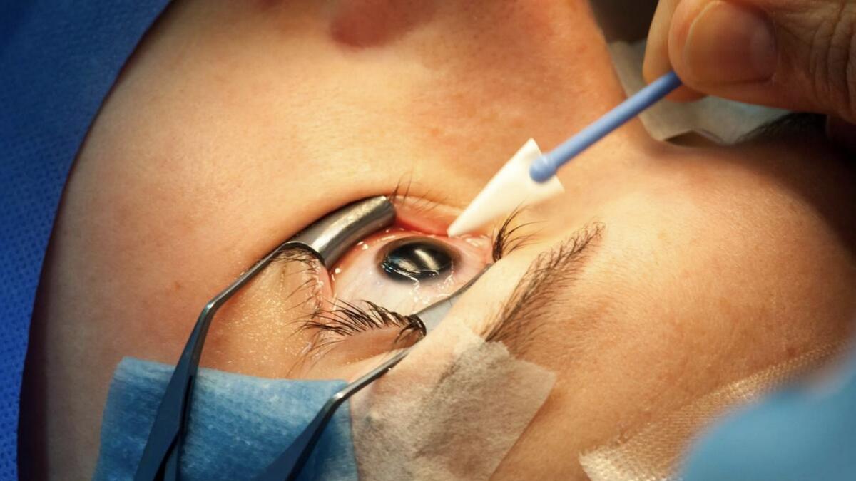 Doctor removes 15cm-long parasitic worm from mans eye