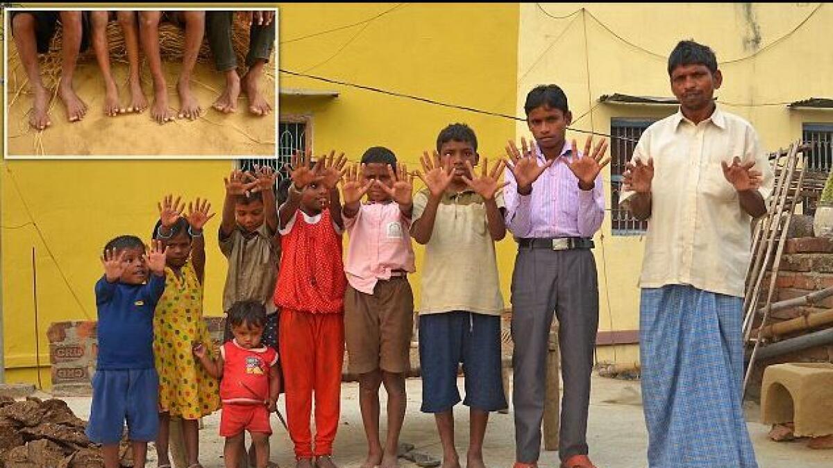 Meet the Indian family with 12 fingers and 12 toes