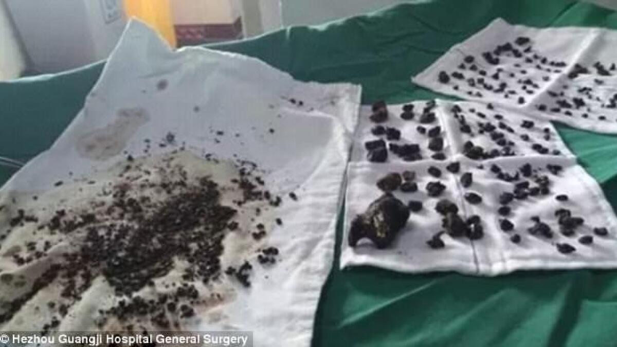 Photos: Over 200 gallstones removed from woman in ONE operation
