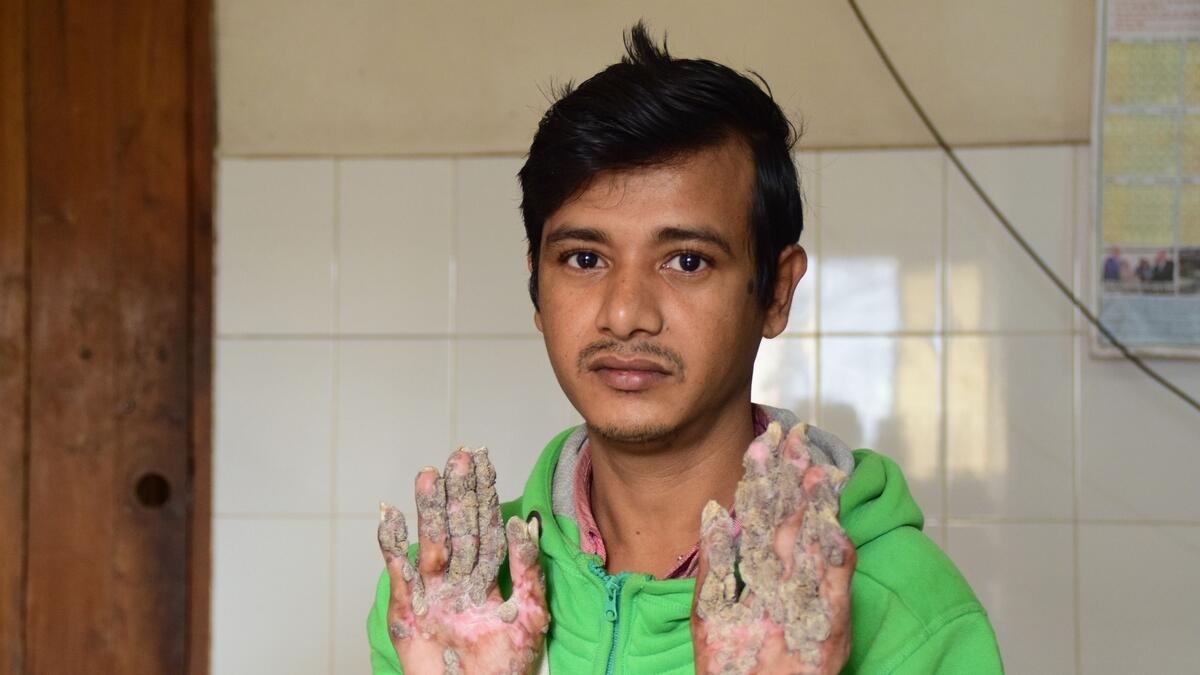 Bangladesh tree man trapped in hospital for two years