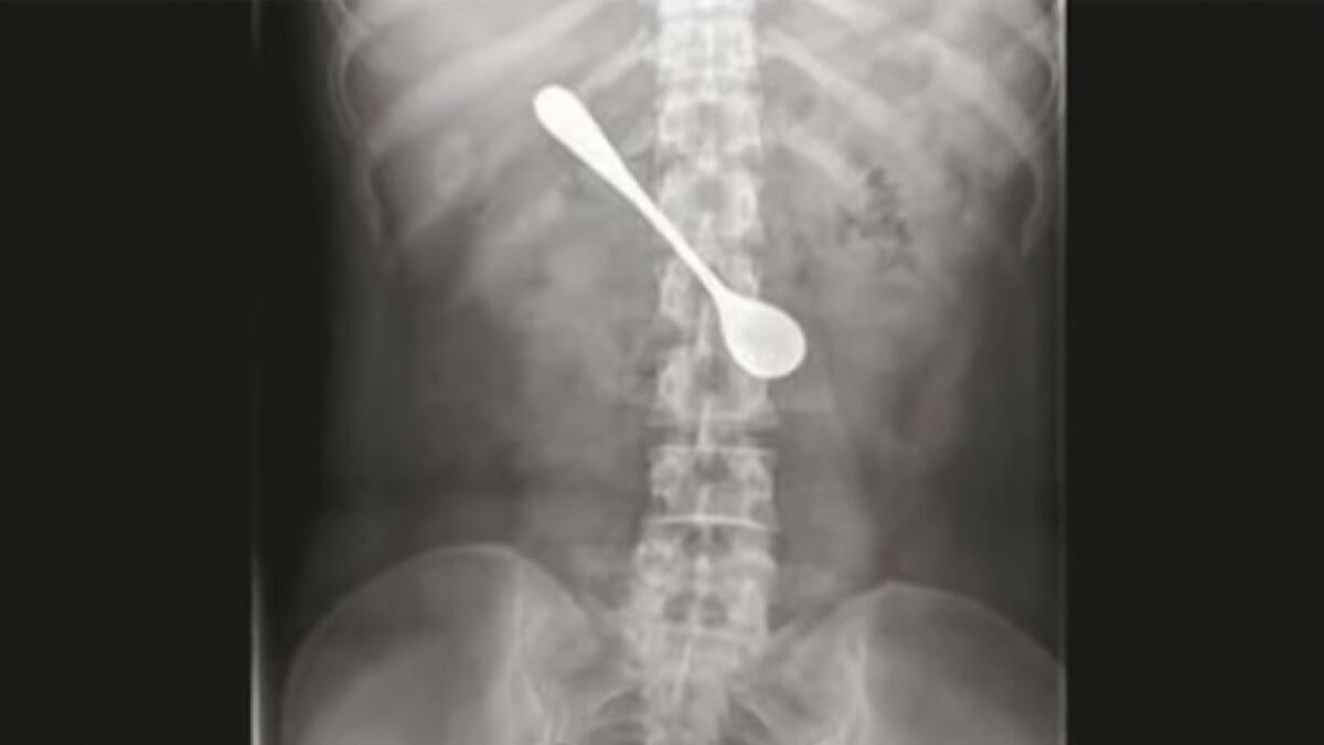 Woman swallows metal spoon, stays in body for days