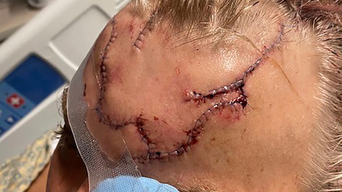 Lacerations on the head of Allen Minish as he recuperates at a hospital in Anchorage, Alaska, following a mauling by a brown bear.
