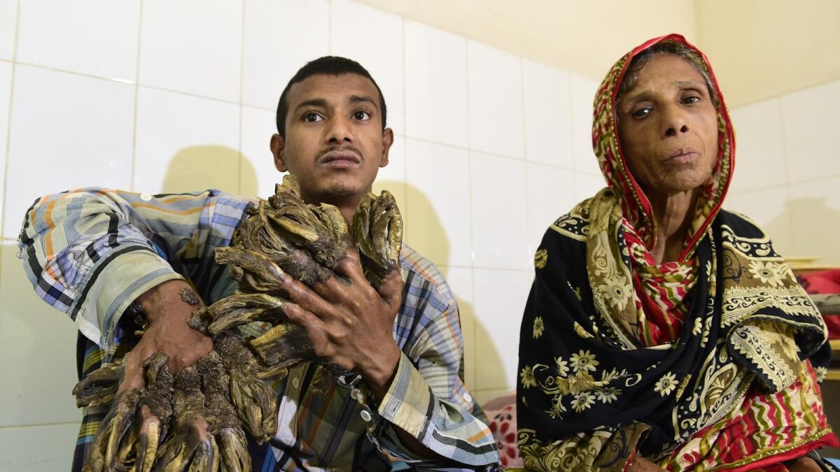 Abul Bajandar (L), 26, dubbed 'Tree Man' for massive bark-like warts on his hands and feet, sits at Dhaka Medical College Hospital in Dhaka on January 31, 2016. AFP photo