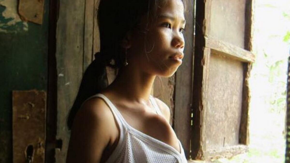 14-year-old Filipina has twin sister growing from her chest 