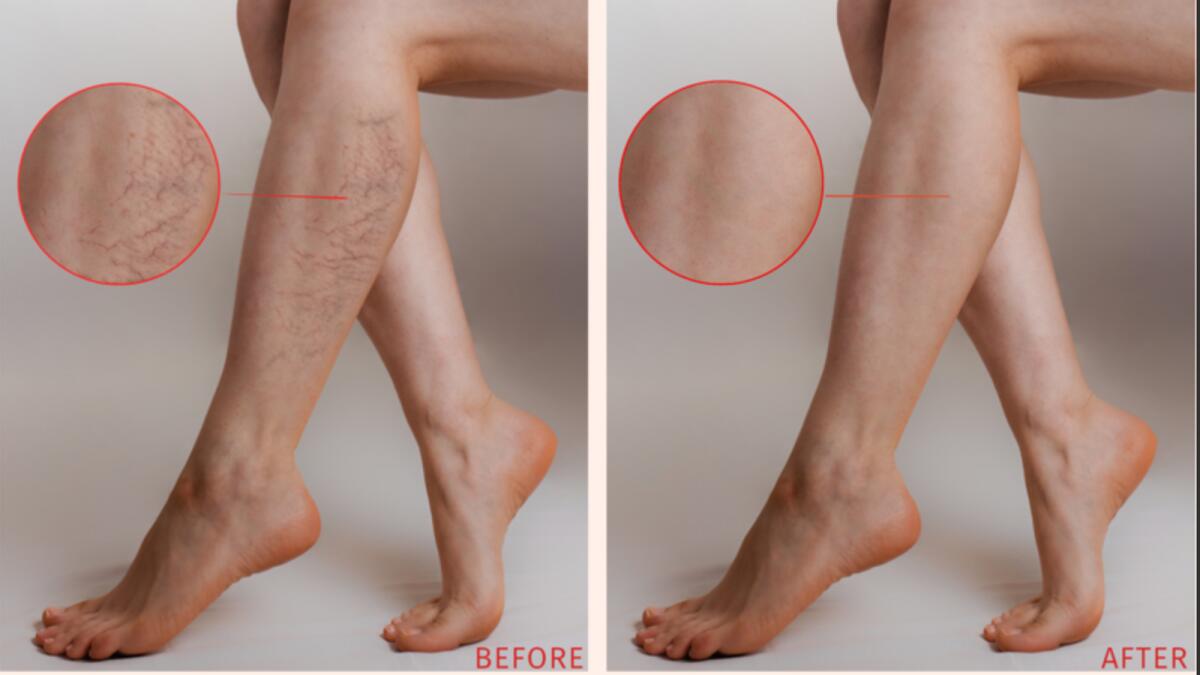 Cosmetic veins, popularly known as spider veins. Photo: Supplied
