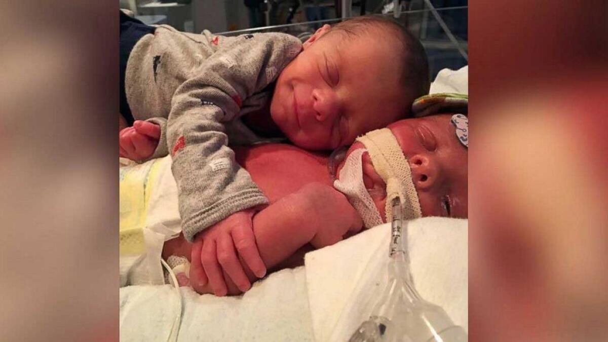 Twin who captured hearts across the internet in viral photo dies