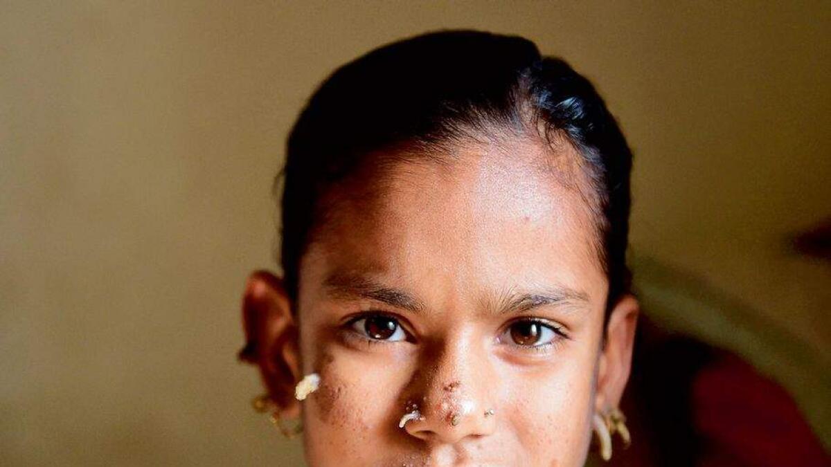 Bangladeshi girl suffers from tree man syndrome