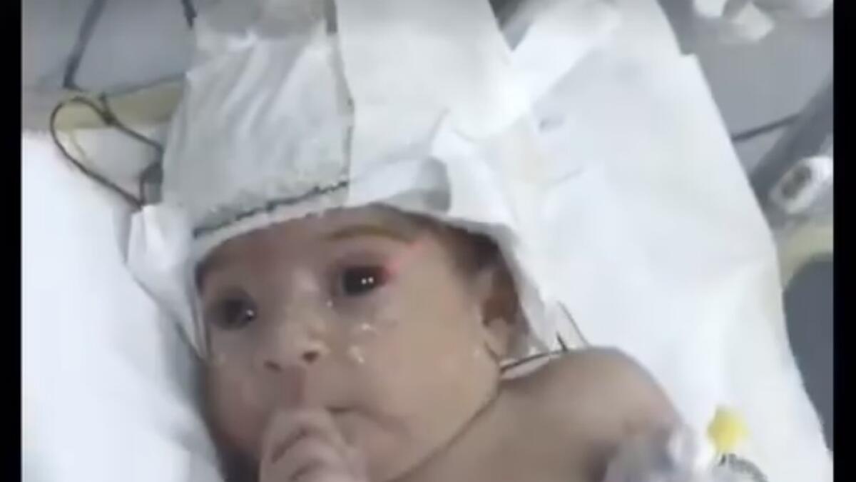 Child born with second head, Ajman Ruler sponsors treatment 