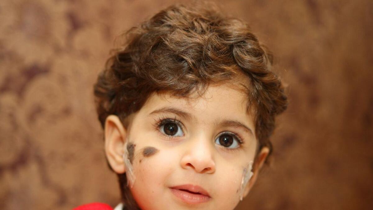 Surgery successful on Saudi babys rare skin condition 