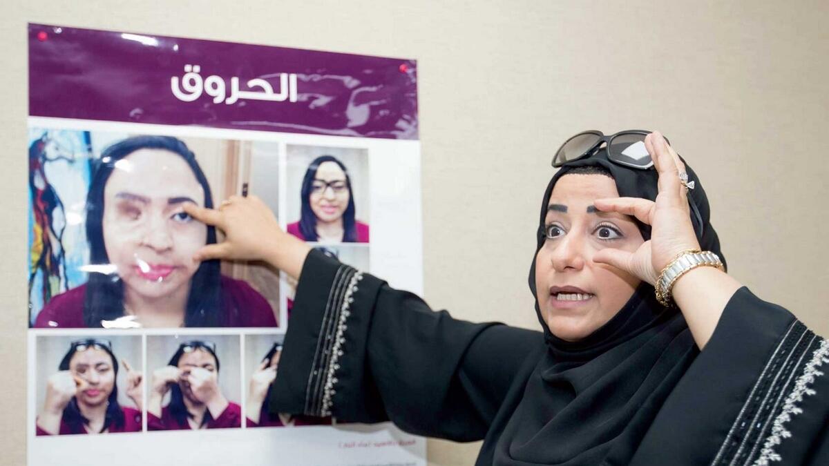Ashwaq Al Hashimi says in many of the acid attack cases, surgeries cannot restore a missing part and victims have to wear prostheses for the rest of their lives.  — Photo by Leslie Pableo