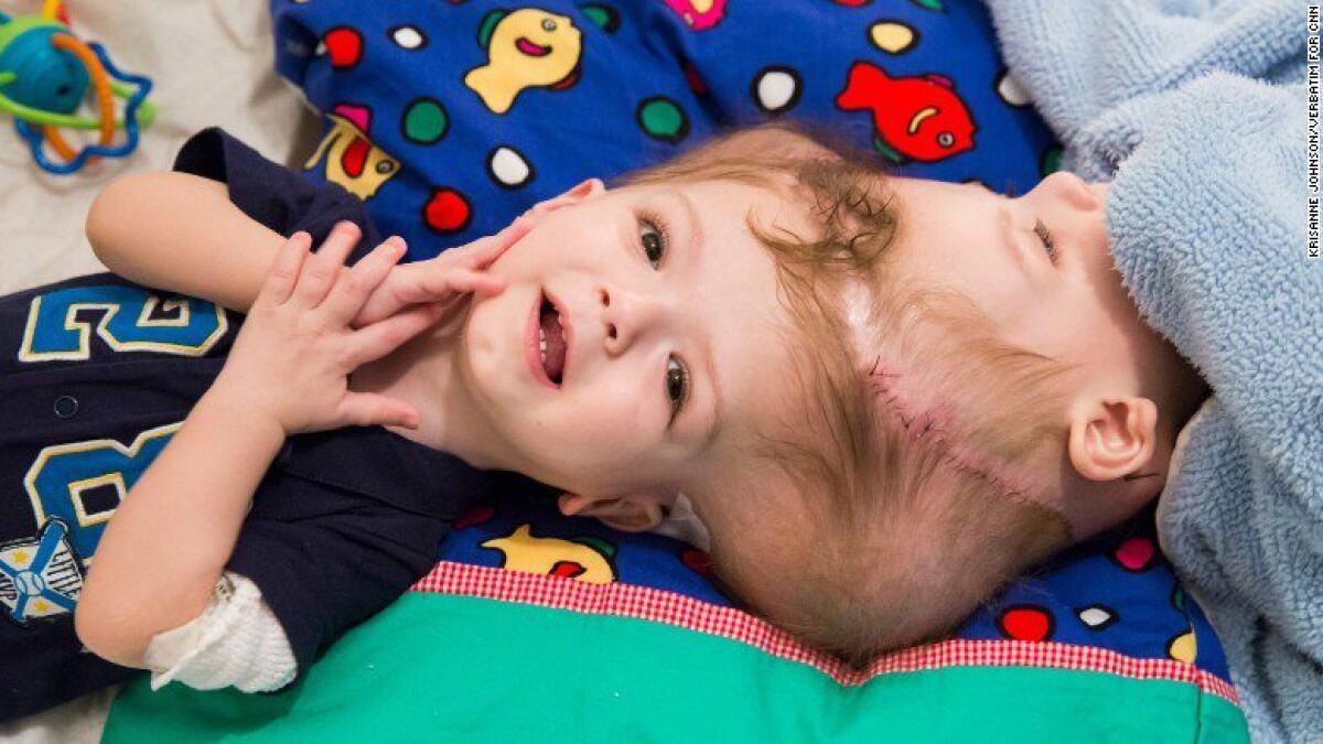 US surgeons separate young CONJOINED twins at head