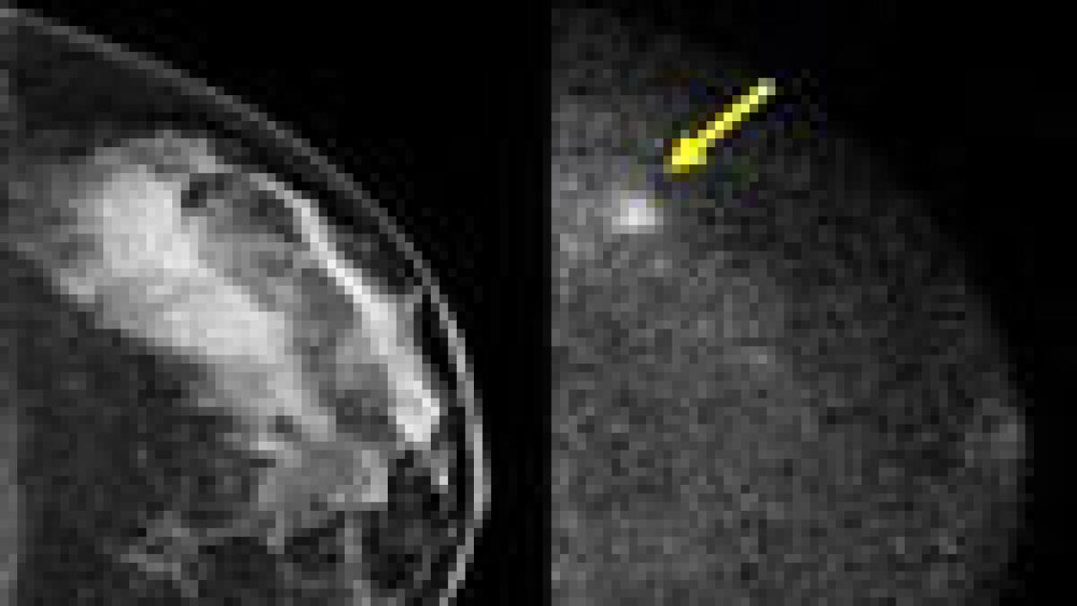 New way to spot breast cancer shows promise