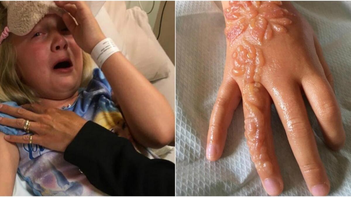 Black henna leaves 7-year-old with horrific burns 