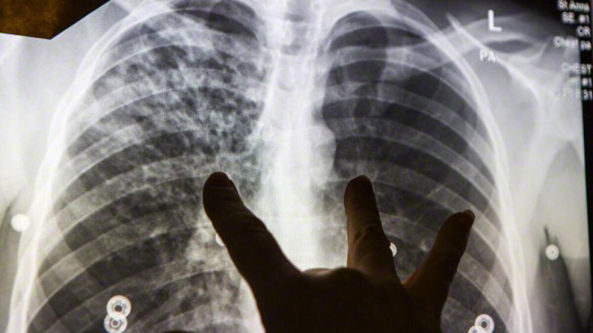 Lifting ban after pneumonia scars mistaken for TB