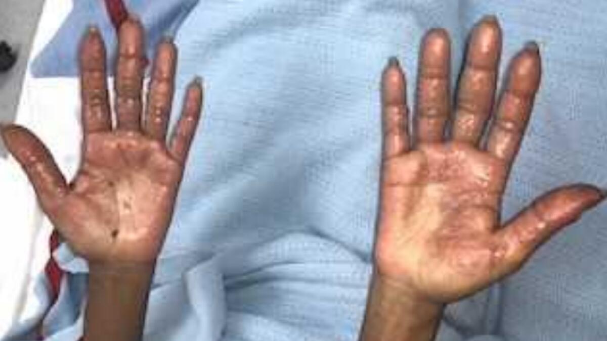 UAE expat suffers burns after using hair dye without gloves 
