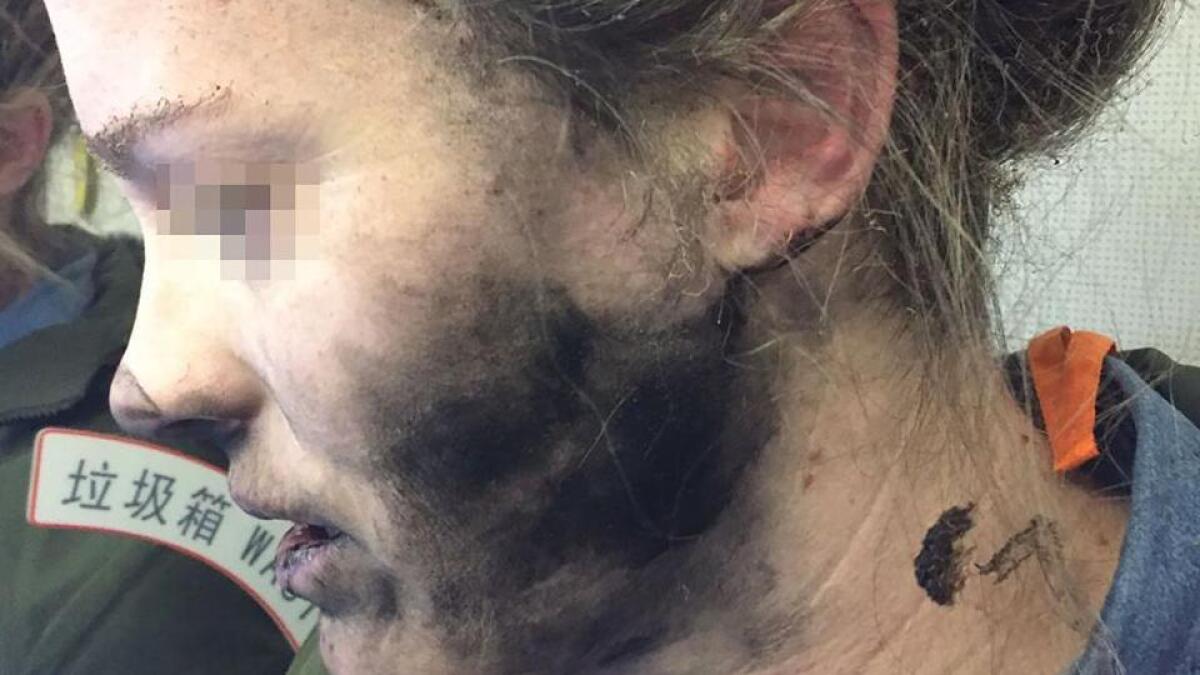 Womans headphones explode on her face during flight