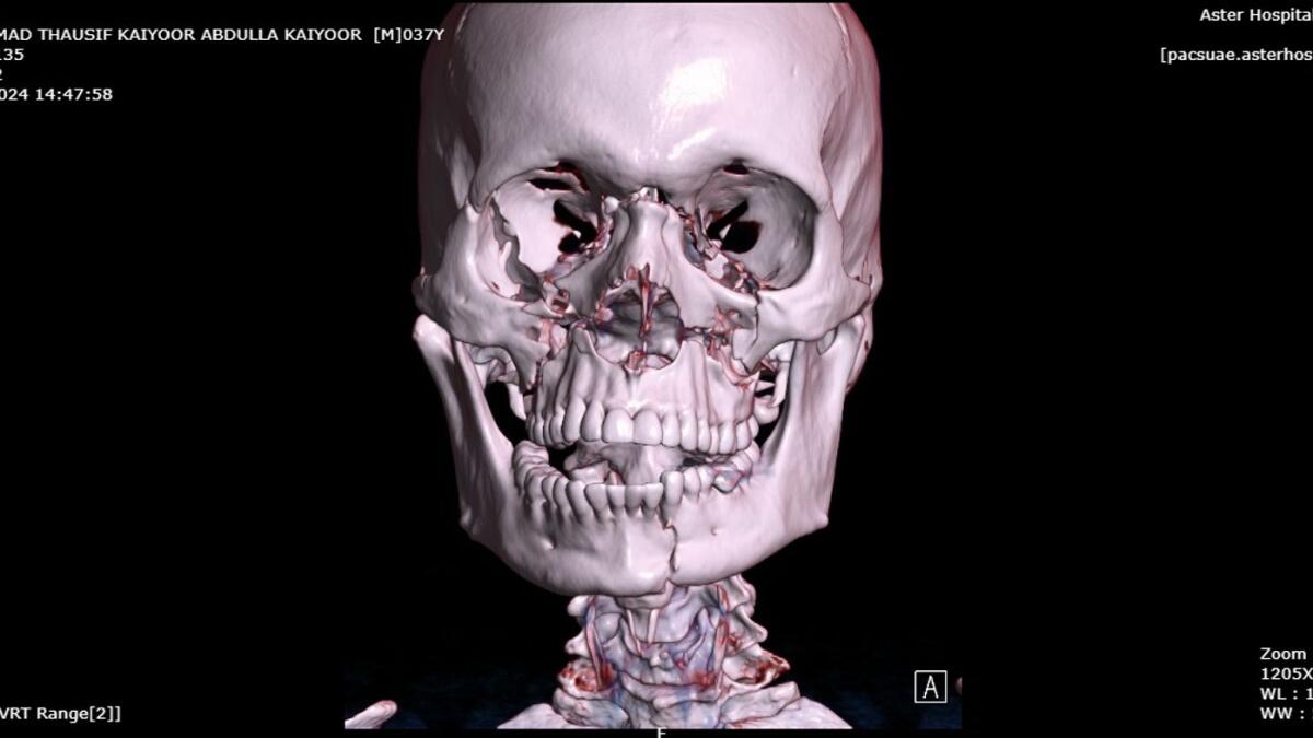 CT scan showing multiple fractures of the maxillofacial skeleton