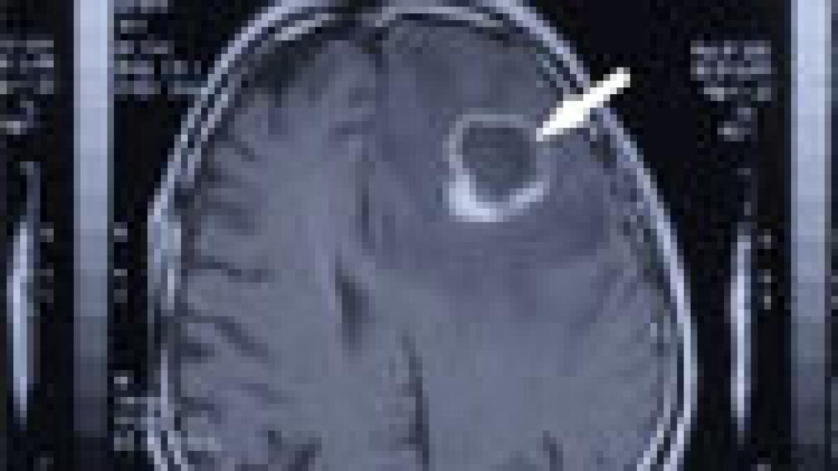 Genome analysis used to decode brain cancer