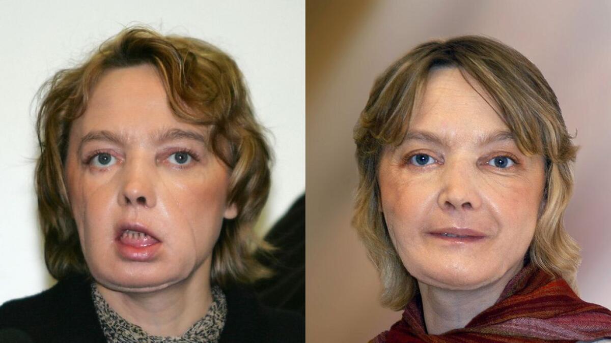 This combination of pictures (dated, (L) February 6, 2006 and (R)from November 2006) of French Isabelle Dinoire, 39, a few months after her surgery operation carried out jointly by an Amiens and Lyon team who underwent the worlds first facial face transp