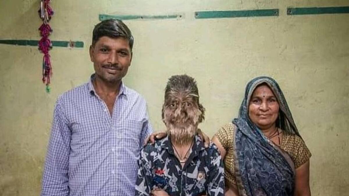 Indian boy has rare ailment that turns him into a werewolf 