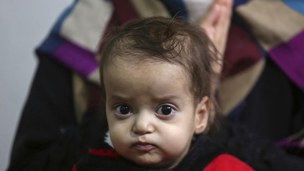 Syrian refugee baby gets life-saving heart surgery