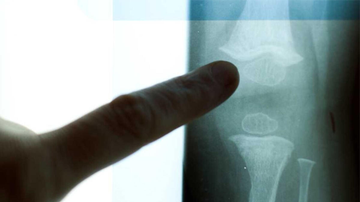 Common anti-depressants linked to bone fracture risk in women