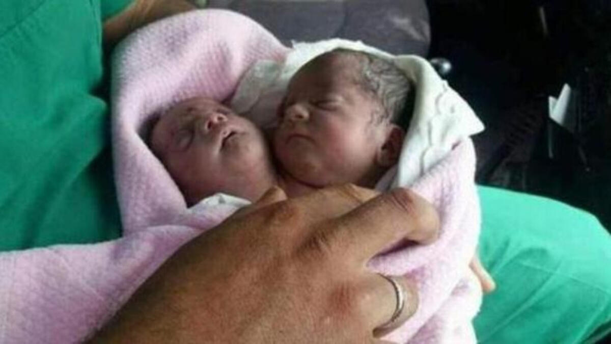 Baby born with two heads in Syria 