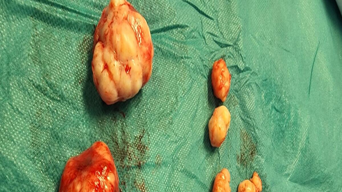 30 fibroids removed during the surgery