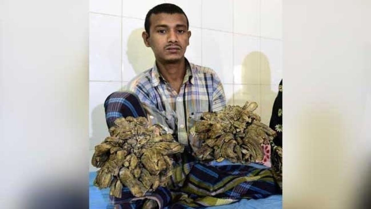 Bangladesh tree man wants hands amputated
