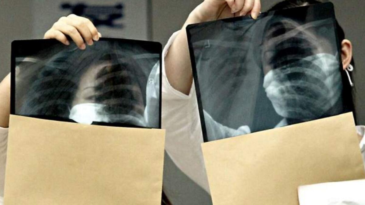 Close relatives suffering from TB can stay in UAE