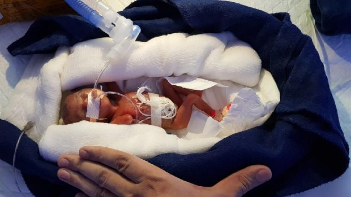 Indian baby girl weighing 400 grams at birth survives