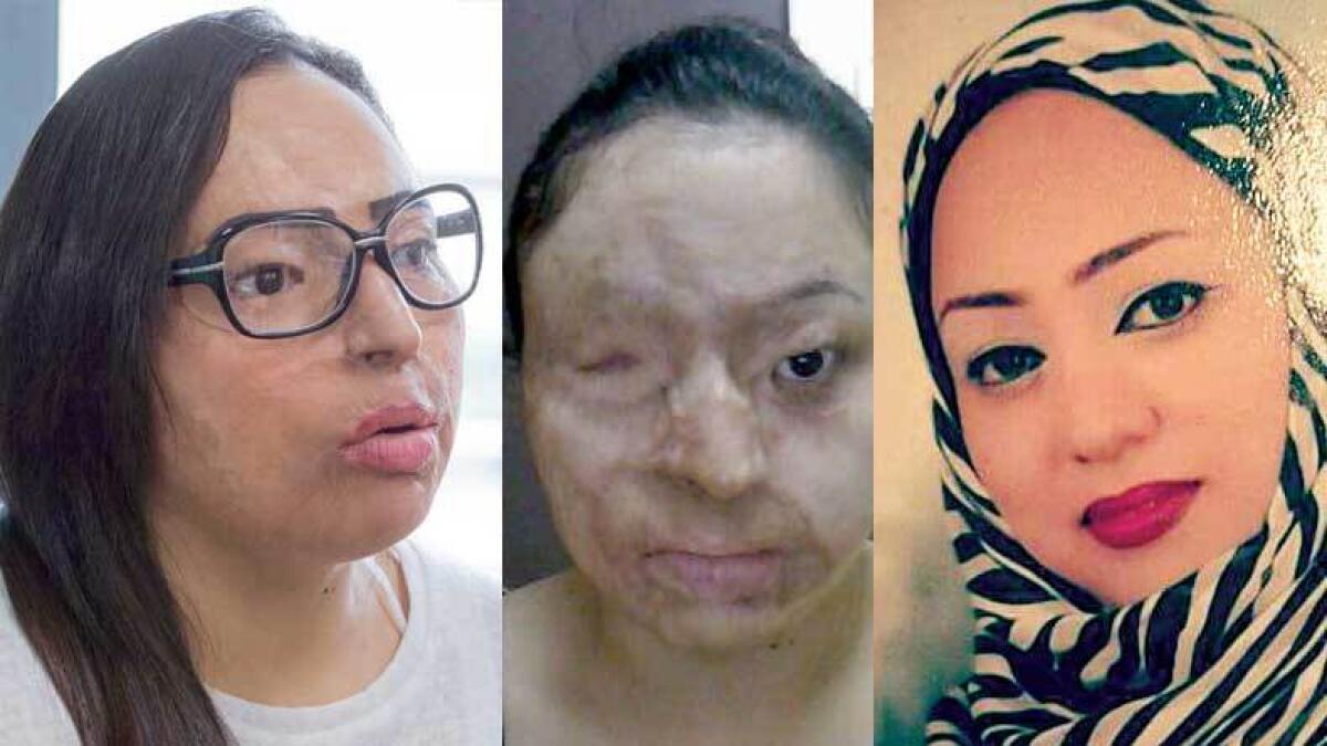 Samar Mosaad before the acid attack in 2011 (right), after the attack (middle), and after receiving treatment in Dubai (left)