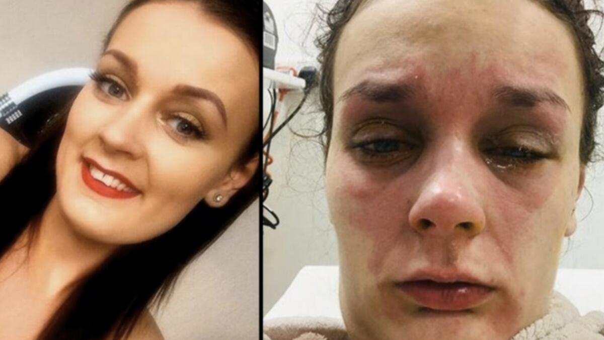 Teenager goes blind after egg explodes in her face 