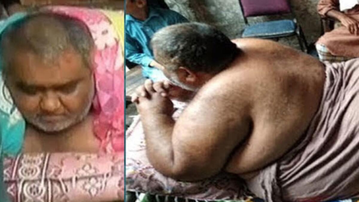 Pakistans Noor Hassan, a victim of obesity, passes away