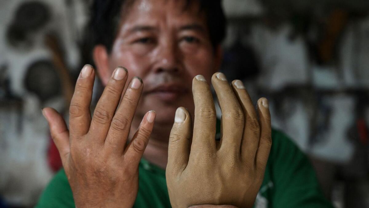 Former leprosy patient Ali Saga displaying a prosthetic hand (R) as he compares it to his own hand inside his workshop in Tangerang, where he makes artificial limbs at affordable prices for people with disabilities.  — AFP