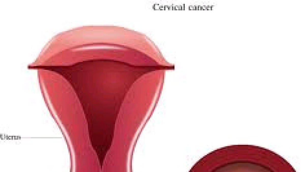 Cervical cancer cases on the rise in UAE